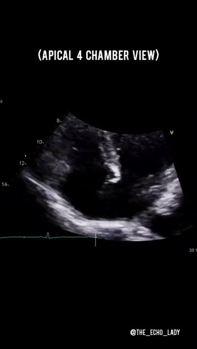 Echo Quiz time! 👇🏻📝🫀🩺