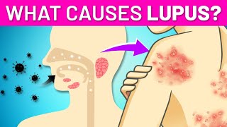 3 Possible Causes of Lupus