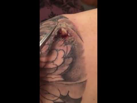 Infected abscess on tattoo - YouTube