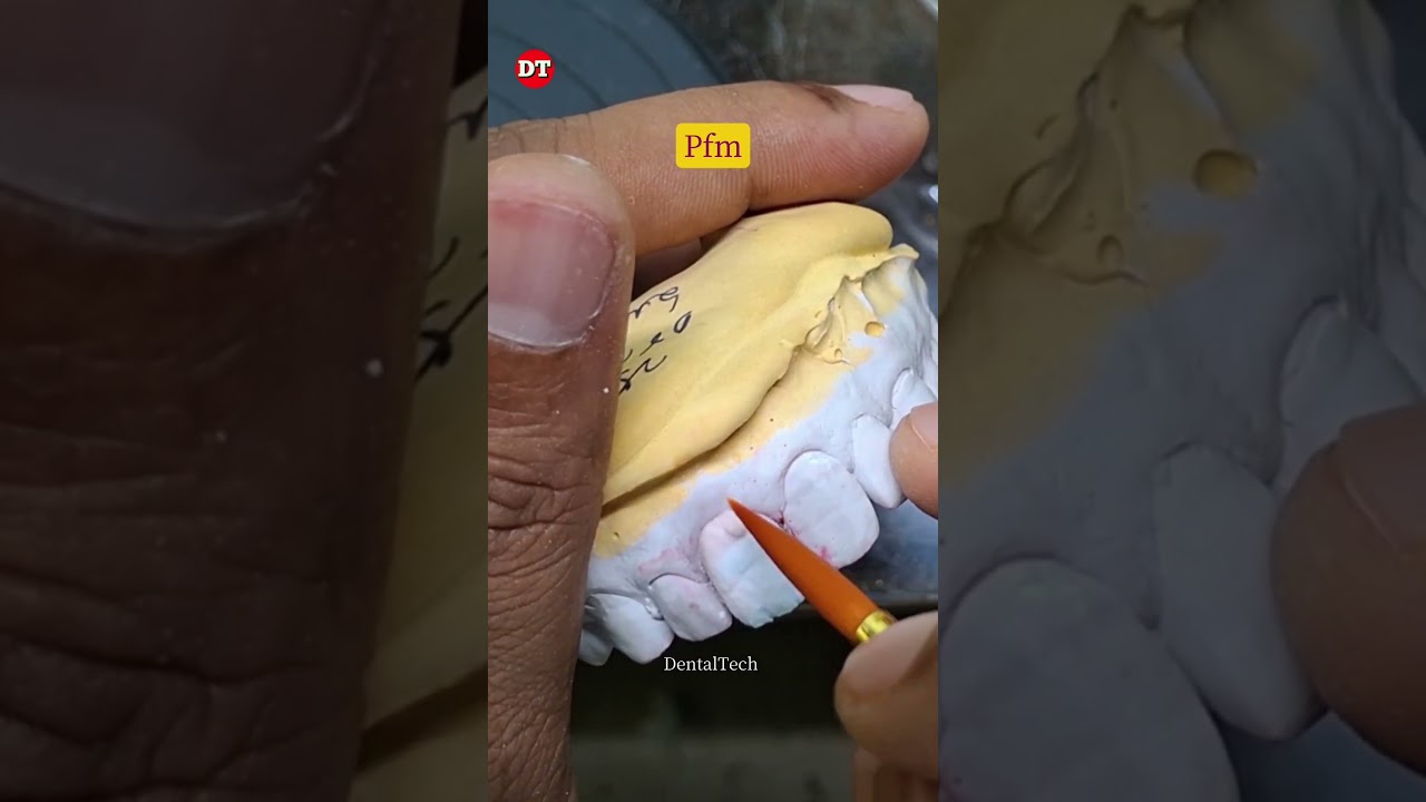 Central Anatomy| anterior Ceramic Porcelain| dental technician| dental lab| laboratory| 