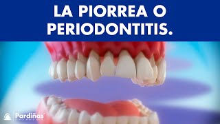 Piorrea o peridontitis - Enfermedad periodontal ©