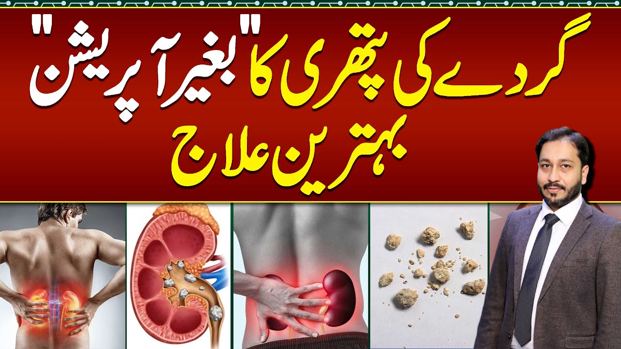 Kidney Stones Treatment without Operation - Kidney Stones Symptoms & Tests - Gurde Ki Pathri Ka ilaj