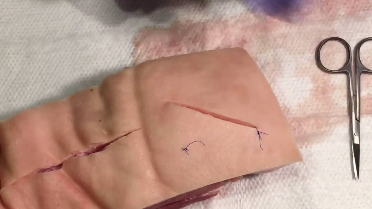 Các loại vết thương khác nhau như thế nào