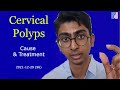 Cervical Polyps Treatment Antai Hospitals Cervical Polyps Treatment Antai Hospitals