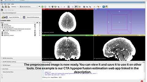 Using the CTA Preprocess 3D Slicer Pipeline