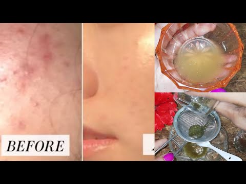 How remove Acne,pimple,acne scars|Acne Serum,Acne Toner, Acne Pack/Flawless Skin Fiza Noor
