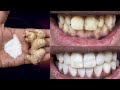 Magical Teeth Whitening Remedy, Get whiten Teeth at home in 3 minutes
