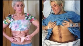 My tummy tuck BEFORE and AFTER