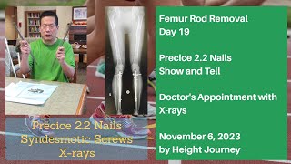 Femur Rod Removal - Day 19, Doctor&#39;s Appointment with X-rays, Precice 2.2 Femur Nails Show and Tell