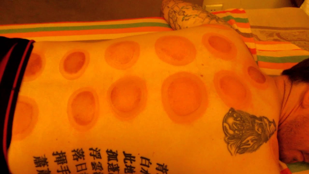 Traditional Chinese fire cupping pt 2.MOV YouTube