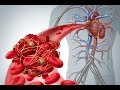 تعرف على الأعراض والعلامات السريرية لجلطة الساق وجلطة الرئة