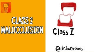Class 1 Malocclusion