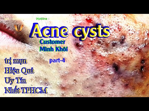 Video Cách Điều Trị Mụn Viêm, Mụn Bọc Hiệu Quả Nhất TPHCM... - youtube