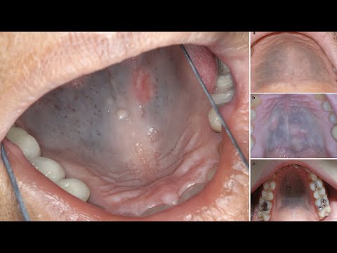 14 Years of Taking This Medication Stained The Roof of Her Mouth! - YouTube