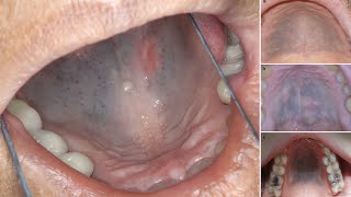 14 Years of Taking This Medication Stained The Roof of Her Mouth! Why The Roof Of Mouth Hurts