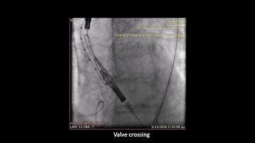 Transfemoral TAVI: Acurate Neo 2