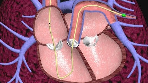 Swan Ganz Pulmonary Artery Catheter Animation by Cal Shipley, M.D.