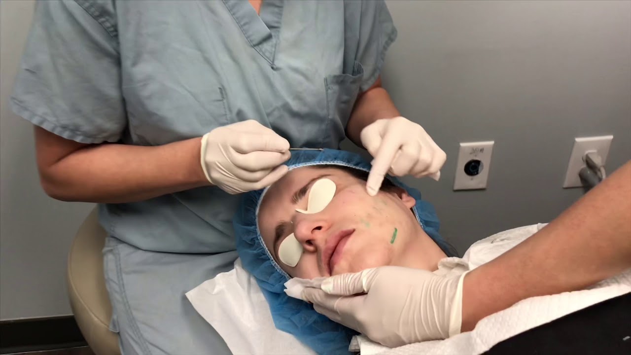 Banner for Dr. Fabi Using InfiniRF to Treat Acne Scars