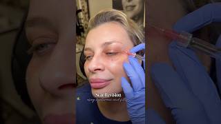 Scar Revision Using Hyaluronic Acid Fillers