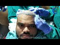 Operation Room ka Video • Hair transplant kese hota he • Best Hair Transplant Live Surgery