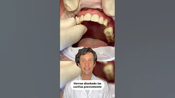 ¿Se pueden poner carillas sólo en los dientes superiores?