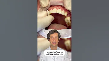 ¿Se pueden poner carillas en los dientes posteriores?