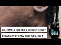 Dr. Pimple Popper's Weekly StoryTime: Steatocystoma Skittles, Chapter 5!