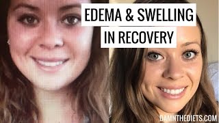 EDEMA - SWELLING - FAT - PUFFINESS IN RECOVERY