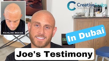 Joes Testimony in Dubai | Faded and Dusty SMP Hairline | Fair hair & light skin.
