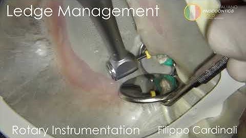 Cardinali - Ledge management with rotary instruments