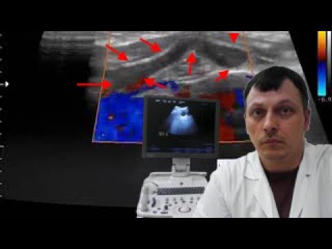 Детское УЗИ костей - Экзостоз vs Синостоз у ребенка