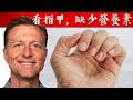 看指甲15狀況，判斷缺少的營養,,自然療法,柏格醫生 Dr Berg