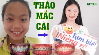 Tháo Mắc Cài điều chỉnh răng lệch lạc, răng nanh mọc cao