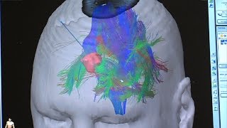 New Imaging Tools Advance Brain Surgery, Part One