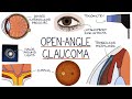 Understanding Open Angle Glaucoma