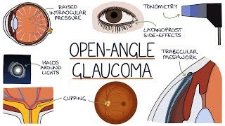 Understanding Open Angle Glaucoma screenshot 5