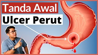 Ulcer Perut | Gastrik & Angin | 5 Tanda Awal Wajib Tahu | Doctor Sani |