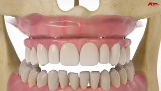 Nobel Biocare All on 4 Dental Implant Reconstruction Animation
