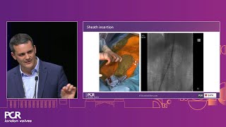 Essentials of lifetime management of TAVI patients - PCR London Valves 2023 screenshot 4