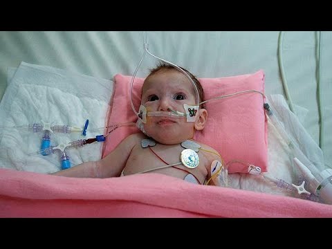 Szétválasztották a gázai sziámi ikreket, az egyik kislány túlélte a műtétet