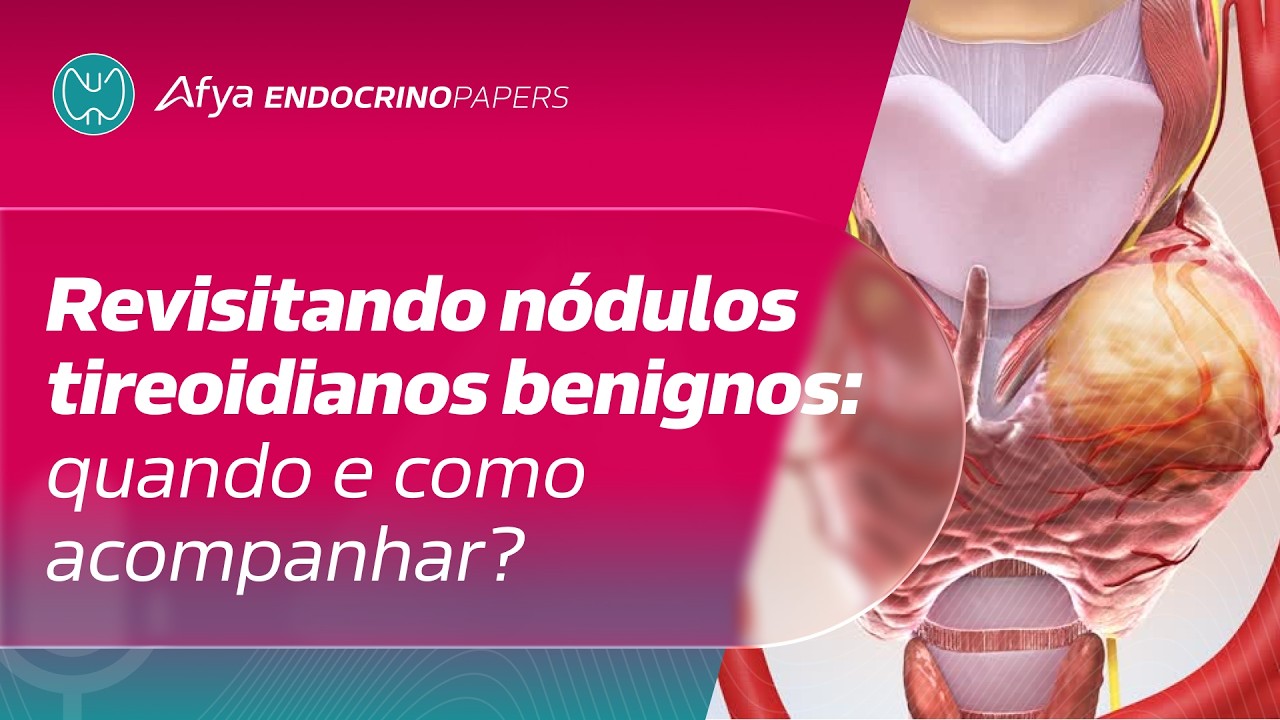 Revisitando nódulos tireoidianos benignos: quando e como acompanhar?