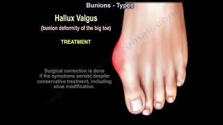 Can High Heels Cause Bunions: Shocking Truth Revealed