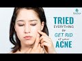 Tried Everything to Get Rid Of Your Acne? | Best Acne Treatment in Delhi | Skinqure