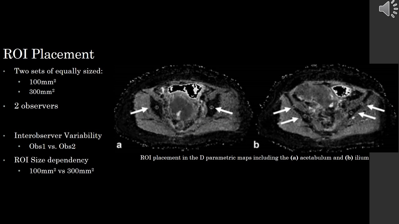 Jose Perucho - Intravoxel Incoherent Motion MRI Assessment of Chemoradiation Induced Changes