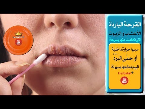 علاج القرحة الباردة للشفتين و الفم بالمنزل