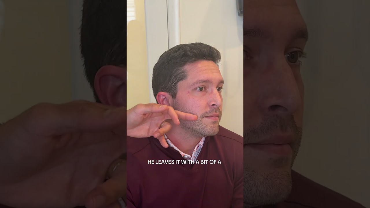 Beard transplant result 1 year post-op | Anthony Bared M.D, FACS | Miami, FL