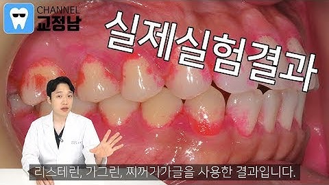 가글, 리스테린, 가그린, 찌꺼기 가글 충격적 실험 후기!!! 구강청결제 효과는 과연?