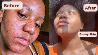 How I Cleared My Acne Hyperpigmentation How I Got Rid Of Textured Skin Got Glass Skin