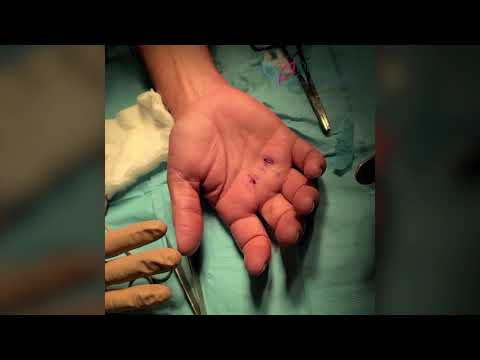 Trigger Finger Decompression Patient 3