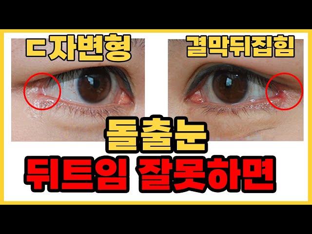 뒤트임 수술 하신 분만 보세요 (ㄷ자변형, 결막노출 빨간흉터,뒤트임복원) │ 눈재수술 전문 라리성형외과